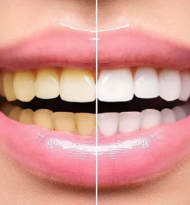 Teeth Whitening (Professional Grade)