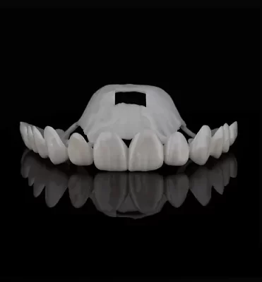 Veneers (Porcelain & Minimal Prep)