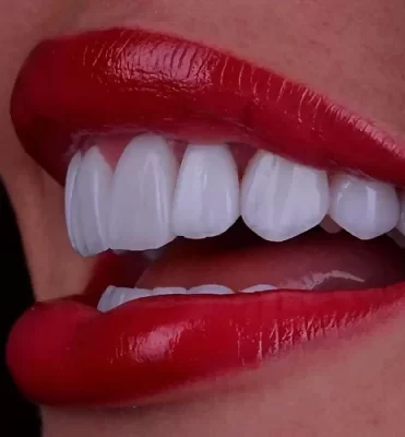Smile Makeover