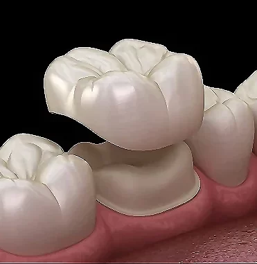 Porcelain Crowns