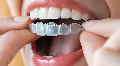 Length of Invisalign Treatment