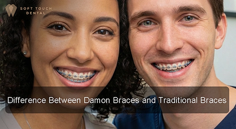 Damon Braces vs Traditional Braces