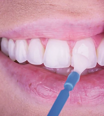 Professional Fluoride Treatment