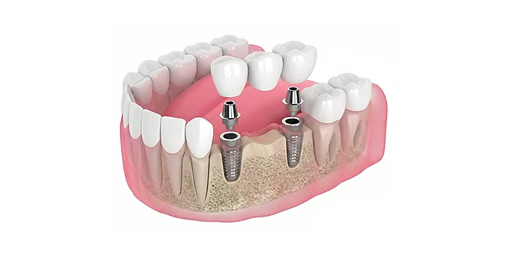 Multiple dental implants