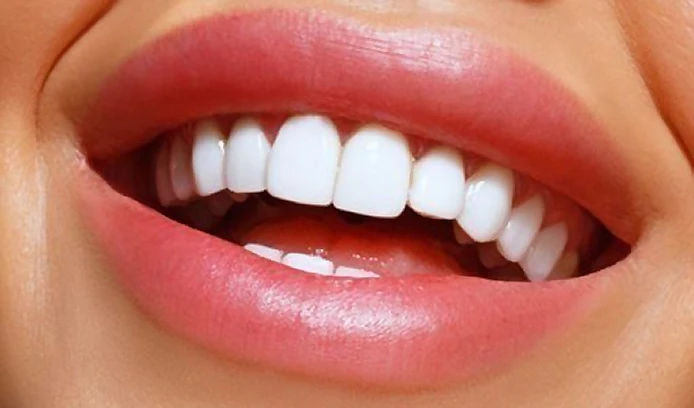 Smile makeover result