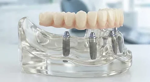 Fewer Implants all on four