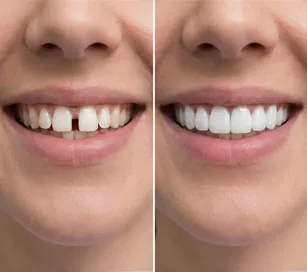 Closing Gaps by veneer