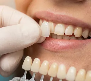 correcting imperfections veneer