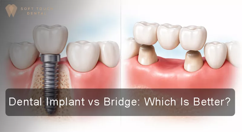Dental Implant vs Bridge