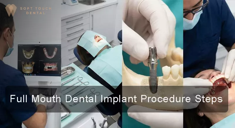 Full Mouth Dental Implant Procedure Steps