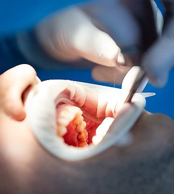 Professional Root Canal Therapy