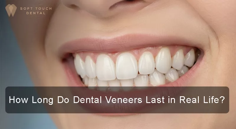 Veneer lifespan