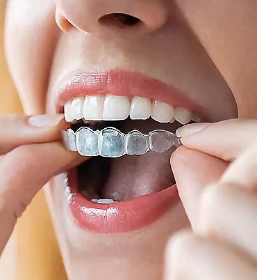Differences Invisalign