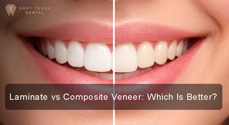 Laminate vs Composite Veneer