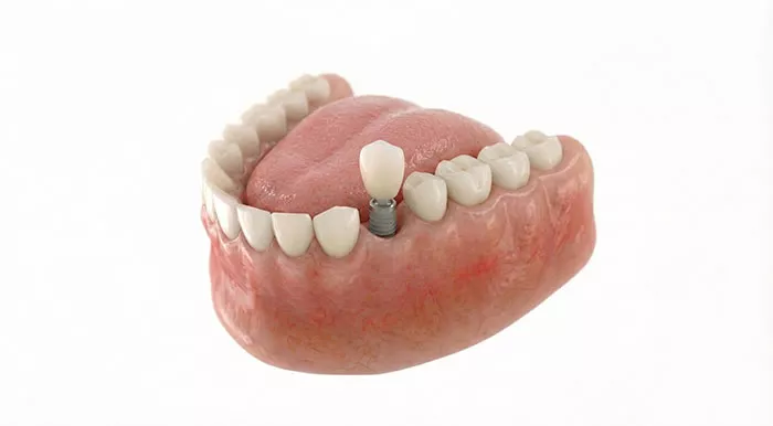 Single dental implant