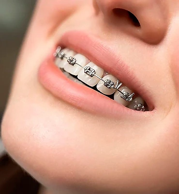 Differences Traditional Braces