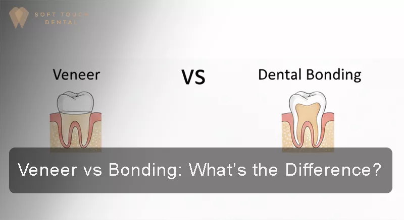 Veneer vs Bonding