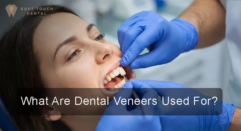 What Are Dental Veneers Used For?