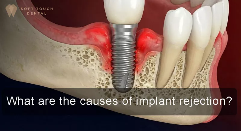causes of implant rejection