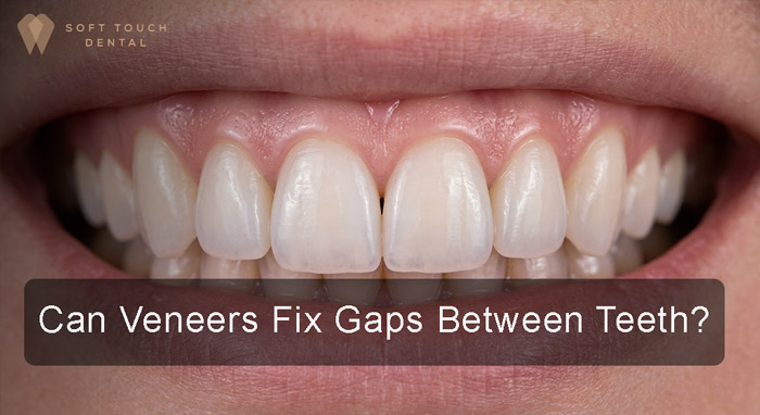 Can Veneers Fix Gaps Between Teeth?
