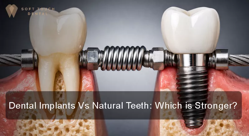 Dental Implants Vs Natural Teeth