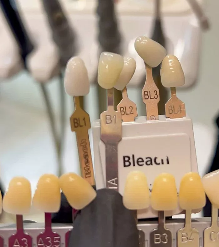 Teeth Veneers in san diego California