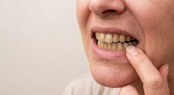 Causes of Tooth Staining