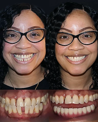 Implantes dentales de boca completa, antes y después del tratamiento