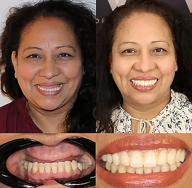 Full mouth rehabilitation bafore and after 1