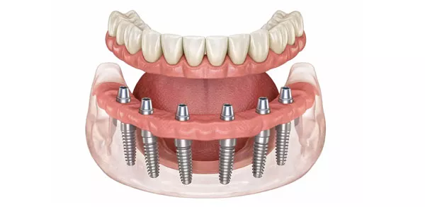 All-On-6 dental implants
