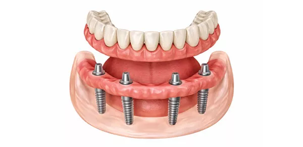 All-On-4 dental implants