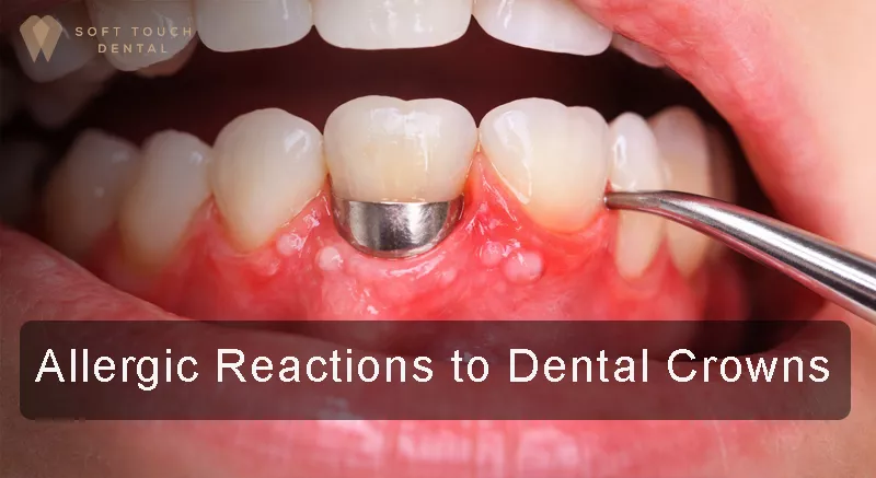 allergic reaction to dental crowns