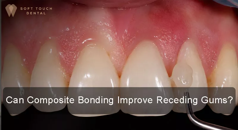 Improving Receding Gums by Composite Bonding