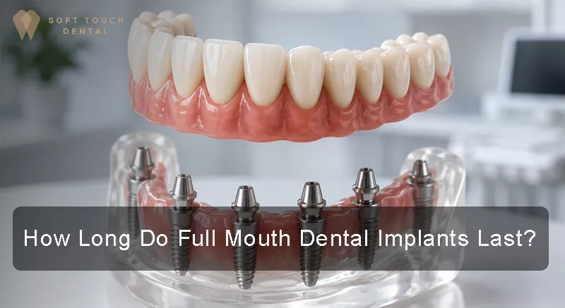 How Long Do Full Mouth Dental Implants Last