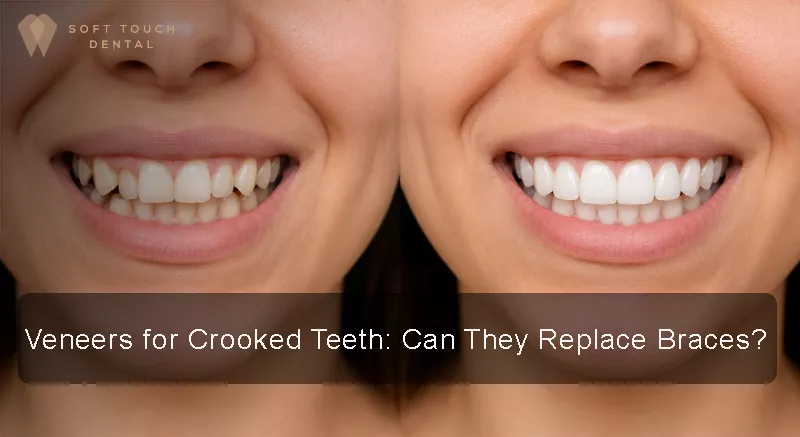 Can Veneers Fix Crooked Teeth?