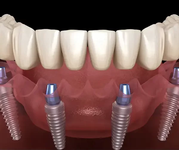 Final Teeth Placement