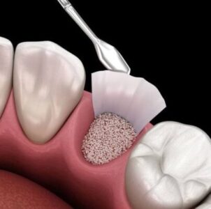 Bone Preservation (If Needed)