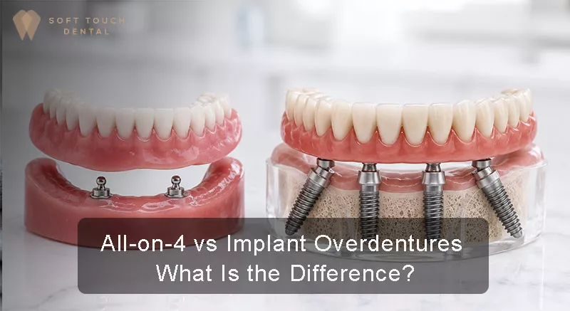 All-on-4 vs Implant Overdentures