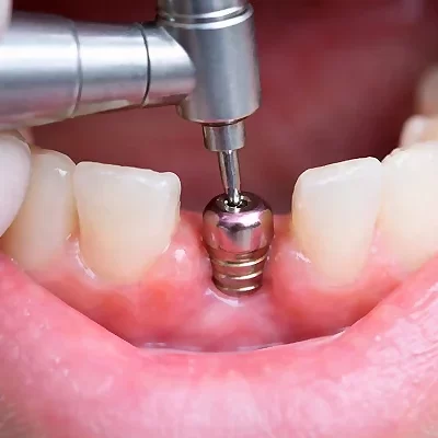 Implant Placement
