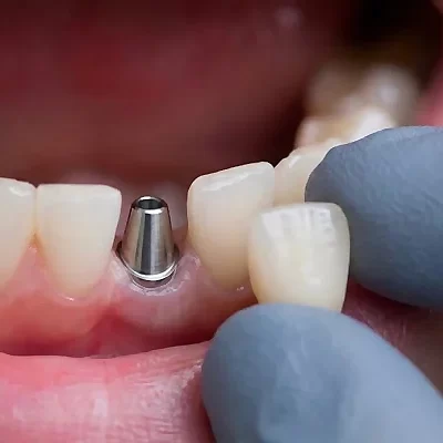 Abutment & Crown Placement
