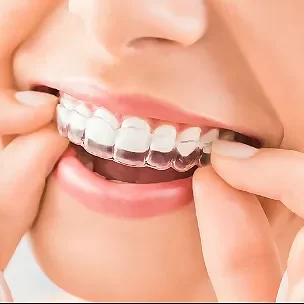 Start Your Aligners