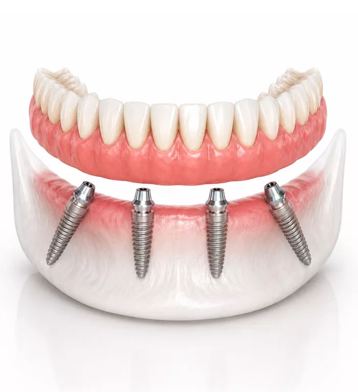 How to take care of dental implants - full-arch implant model