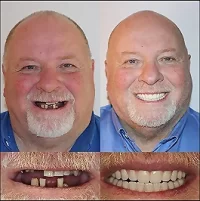All-on-4 patient before and after