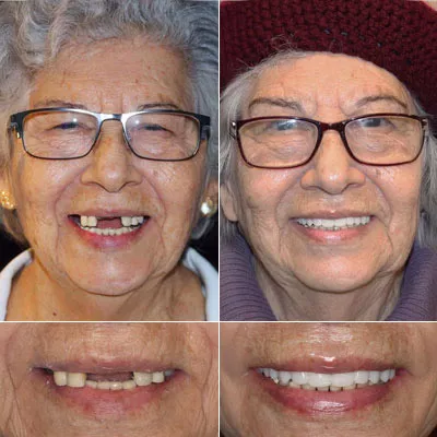 Dental implant patient before and after