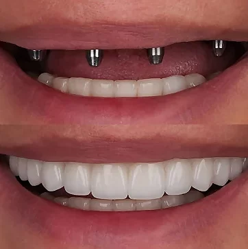 Final Teeth Placement