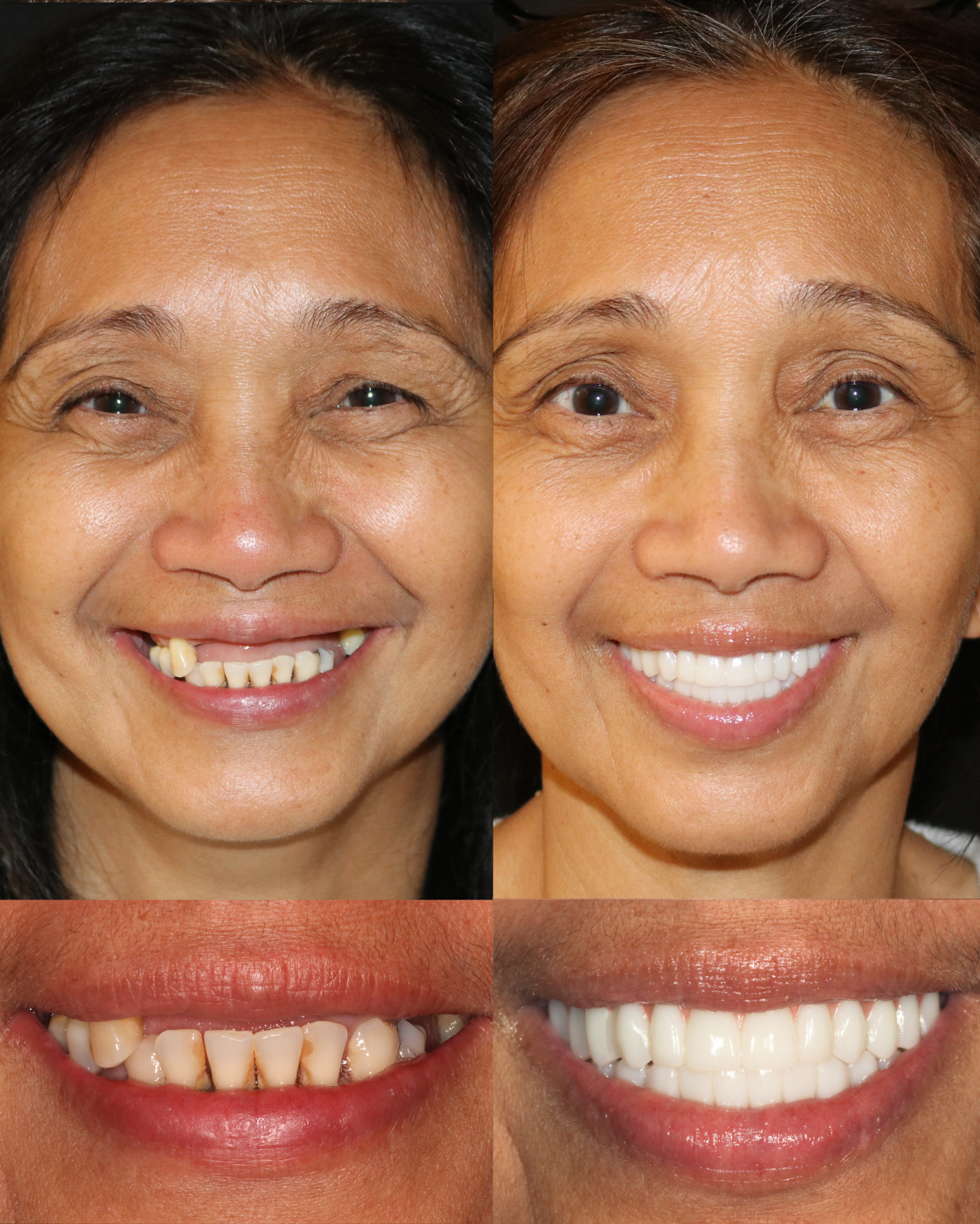 Real Soft Touch Dental patient smile transformation before and after treatment