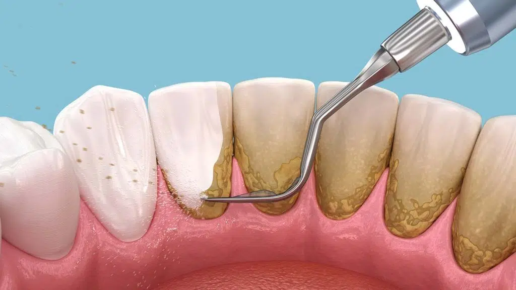 Gentle Tartar Removal