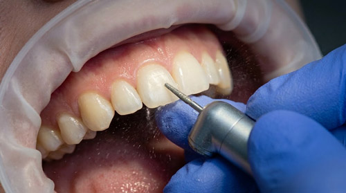 Tooth Preparation & Buffing